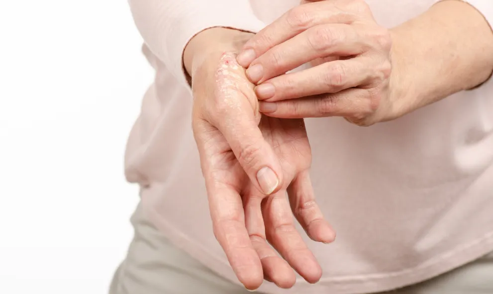 Female hands psoriasis on white background
