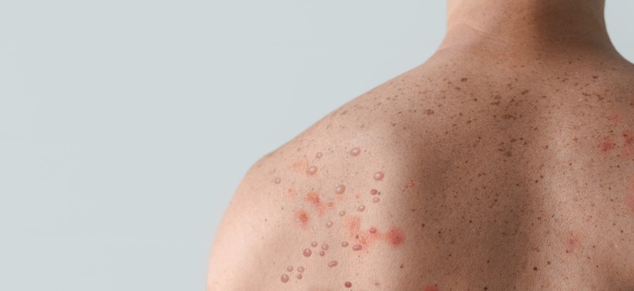 Person with blisters on back