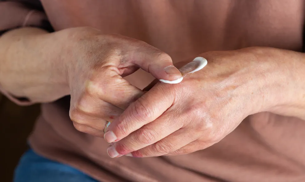 Woman applying cream to her hands with psoriasis
