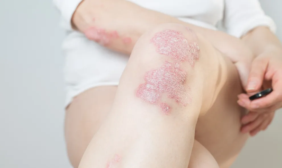 Woman living with psoriasis