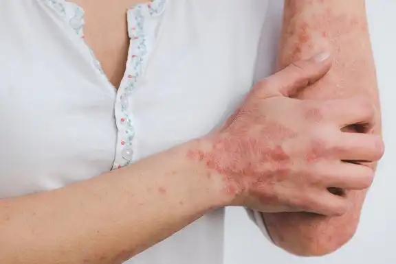 Woman scratching scaly skin