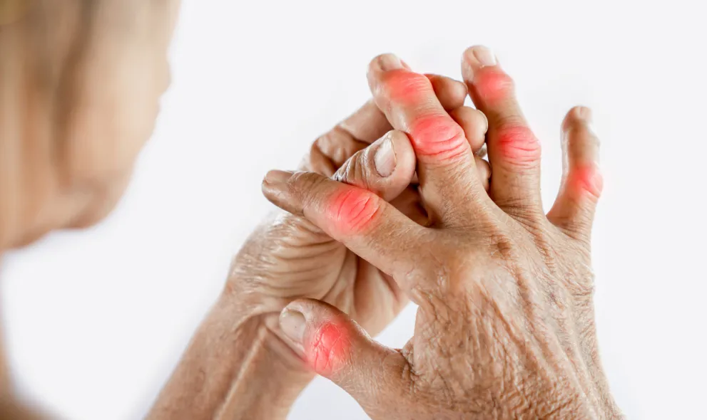 Woman suffering from gout joint pain in fingers